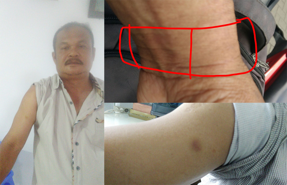 Kasus Salah Tangkap Terjadi Lagi, Kasiruddin Zendrato Babak Belur Dianiaya Oknum Ditnarkoba Mabes Polri