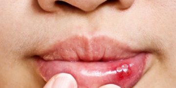 ilustrasi sariawan (freepek)