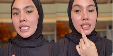 Kartika Putri Mengidap Penyakit Steven Johnson Syndrom (SJS) (Dok. IG/kartikaputriworld
